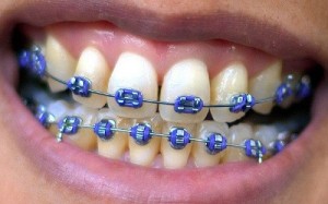 blue braces